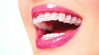 براکت سرامیکی | دکتر سعید قریشی دندانپزشکی کودکان