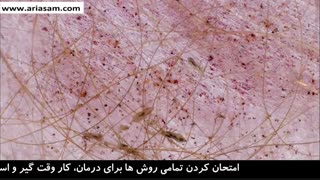 نمای نزدیک از خونخواری شپش