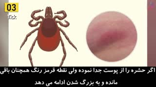 نیش زدن شپش