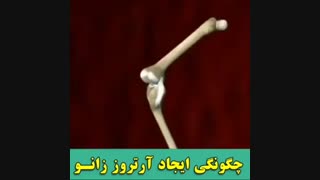 دلایل ایجاد ارتروز زانو