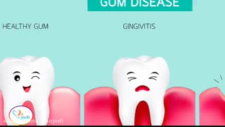 جراحی لثه با لیزر - بیماری های لثه بلیچینگ دندان