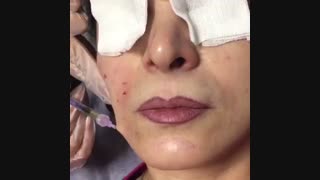 جوانسازی صورت با مزوتراپی دندان مصنوعی