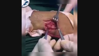 ناپایدارى مفصل کارپومتاکارپ پنجم دست راست