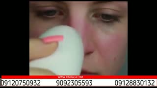 میکرودروم | میکرودرم بی سیم | میکرودرم ابریژن | فواید میکرودرم | پاکسازی پوست | جوان سازی پوست | کیم کالا | 9120750932 لیفت پیشانی