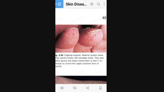 اکزمای انگشت www.ebiderm.blogfa.com