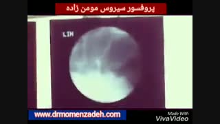 عمل لیزر دیسک کمر بدون نیاز به جراحی باز توسط پروفسور سیروس مومن زاده