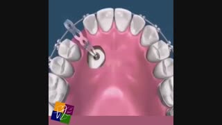 حرکت دندان نیش نهفته داخل فک به سمت قوس دندانى