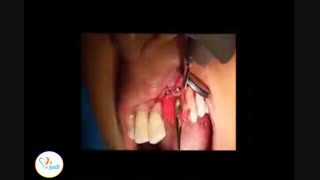 جراحی جایگذاری ایمپلنت و بازسازی همزمان استخوان