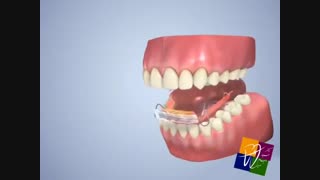 الاینر فنری ها جهت درمان نامنظمی های کوچک دندان های جلویی یا قدامی