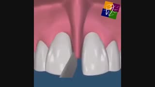 بستن فضای بین دندانی به کمک یک جراحی کوچک