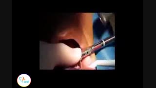 جراحی یک واحد ایمپلنت دندان شماره 5