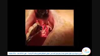 جایگذاری ایمپلنت و بازسازی همزمان استخوان