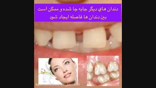 ایمپلنت دندان