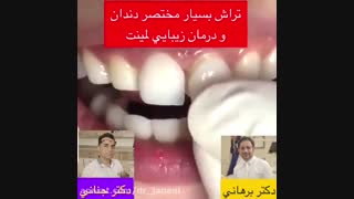 لمینت دندان اصلاح فرم صورت