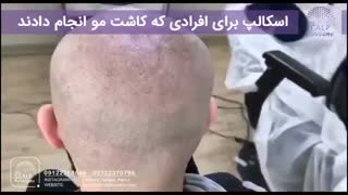 اسکالپ برای کسی که کاشت مو انجام داده