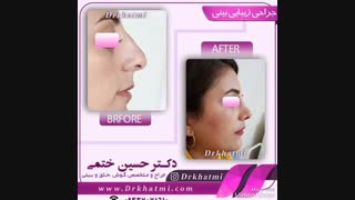 نمونه جراحی زیبایی بینی توسط دکتر حسین ختمی