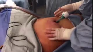 فیلم عمل لاپاراسکوپی