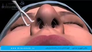جراحی زیبایی بینی