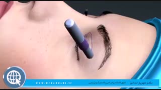 جراحی زیبایی پلک
