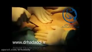ابدومینوپلاستی