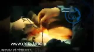 فیلم ابدومینوپلاستی