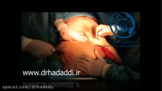 ابدومینوپلاستی