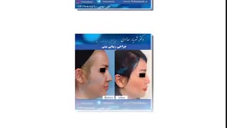 جراحی بینی