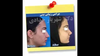 نمونه جراحی بینی دکتر حدادی