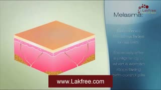 ملاسما یا لک بارداری چیست؟