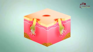 آکنه چیست؟