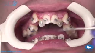 آموزش کامل نحوه ی نصب کامل ارتودنسی