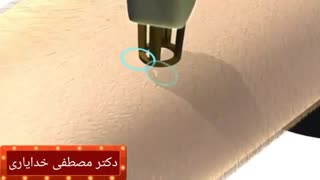 لیزر موهای زائد