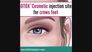 تاثیر تزریقات زیبایی در صورت