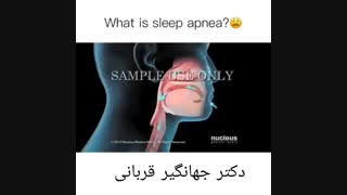 آپنه انسدادی خواب