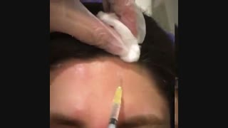 تزریق بوتاکس پیلینگ