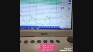 ضربان قلب نوزاد