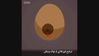 علائم سرطان پستان