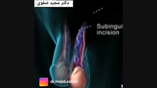 روش های جراحی برای واریکوسل