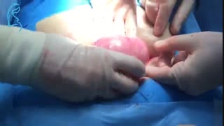 میوم رحم