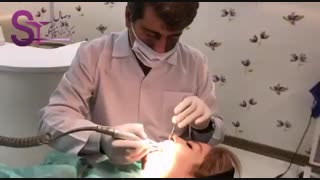 کامپوزیت ونیر فک بالا