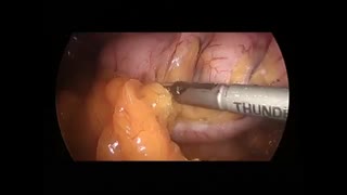 عمل جراحی اسلیو معده ی لاپاروسکوپیک توسط دکتر زهره ضرغامی فرد