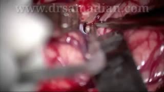 جراحی تومور عصب بینایی با حفظ کره چشم