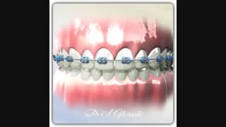 Diastema closure | dr.saeed ghorashi
