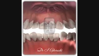 dr.saeed ghorashi  |  Lingual braces