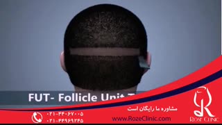 کاشت مو | فیلم کاشت مو | کلینیک پوست و مو رز | شماره 12