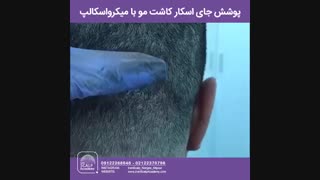 برطرف کردن جای اسکار کاشت مو