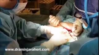 جراحی تعویض کامل مفصل لگن توسط دکتر علیرضا امین جواهری