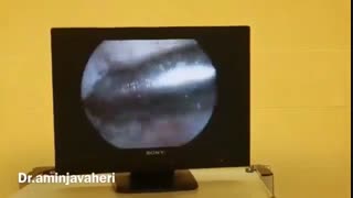 آرتروسکوپی بازسازی رباط صلیبی زانو توسط دکتر علیرضا امین جواهری