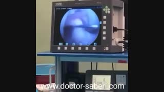 توضیح پارگی رباط صلیبی حین عمل توسط دکتر صابری اتوپلاستی