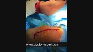جراحی تعویض مفصل دو طرفه همزمان